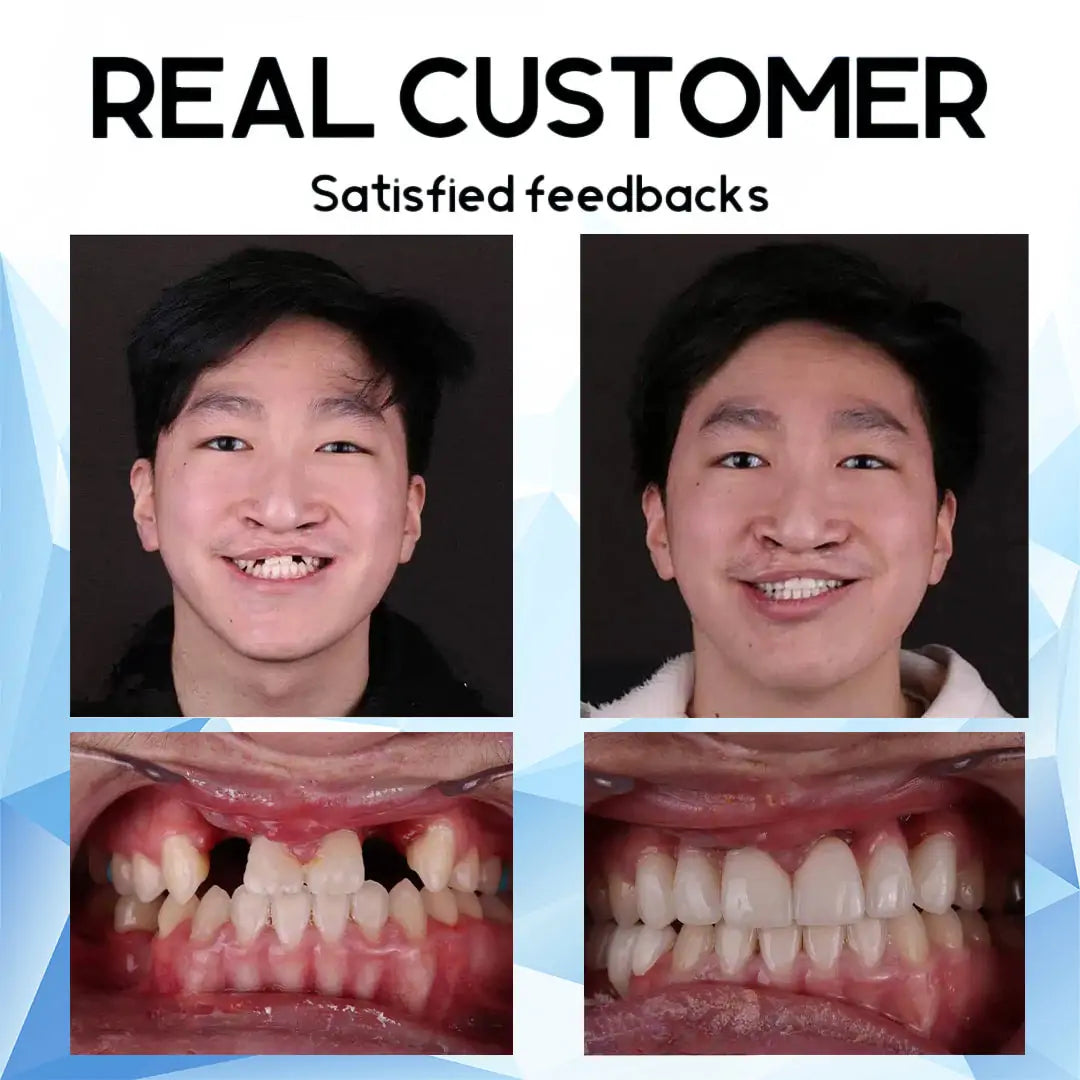 SmilePro™ Smiling Confidence All Day Long