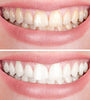 SmileLuxe™ Instant Fresh Smile Magic