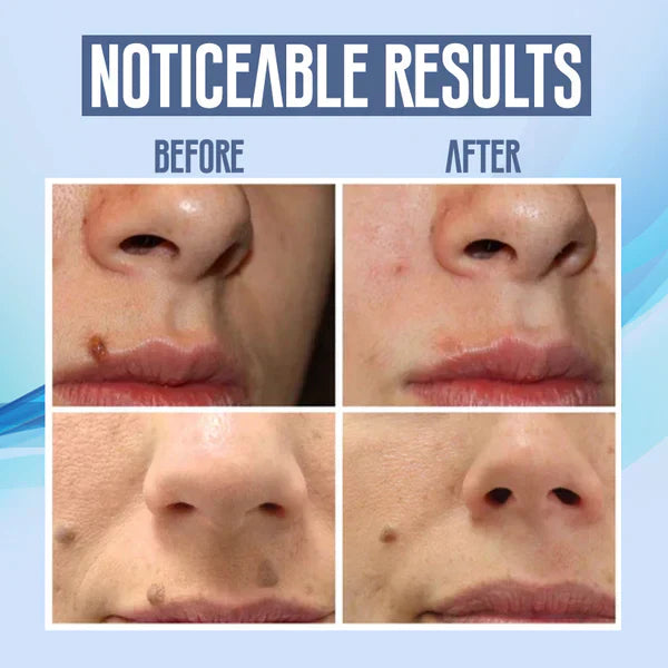 SpotClear™ Dark Spot Vanisher in Just a Few Weeks