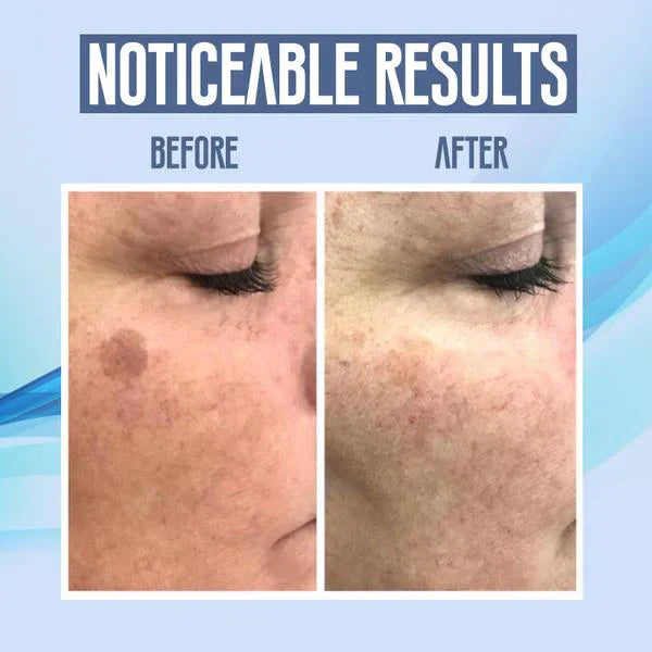 SpotClear™ Dark Spot Vanisher in Just a Few Weeks