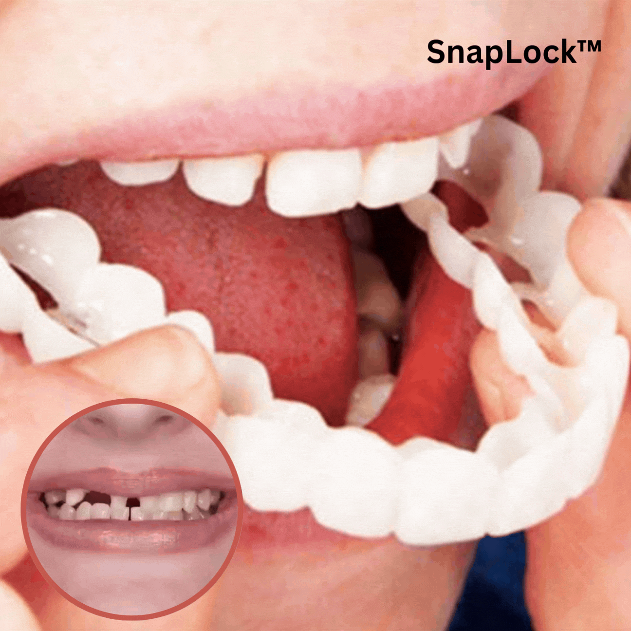 SnapLock™ Snap-In Dentures